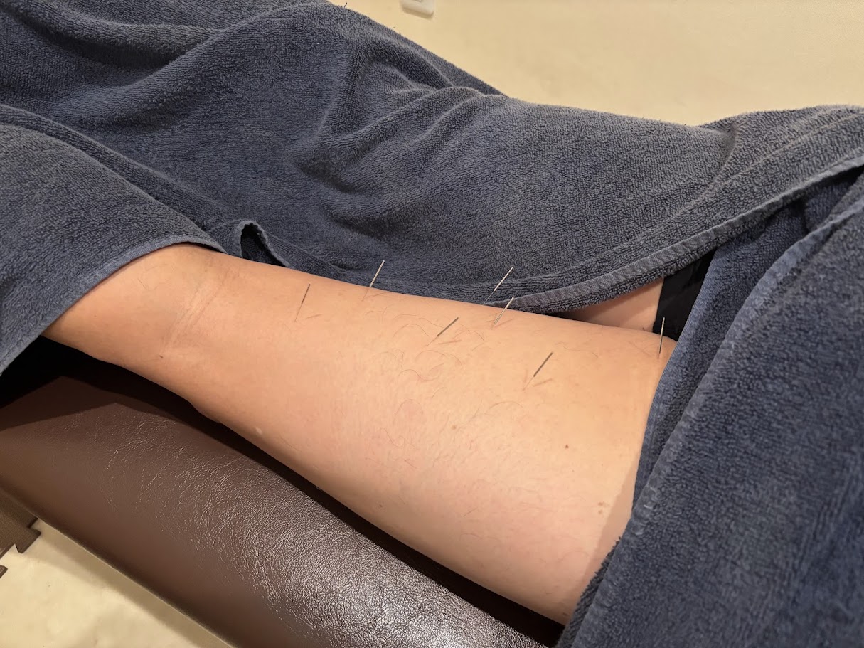 右大腿後面の違和感に対する施術の様子。（鍼の写真）